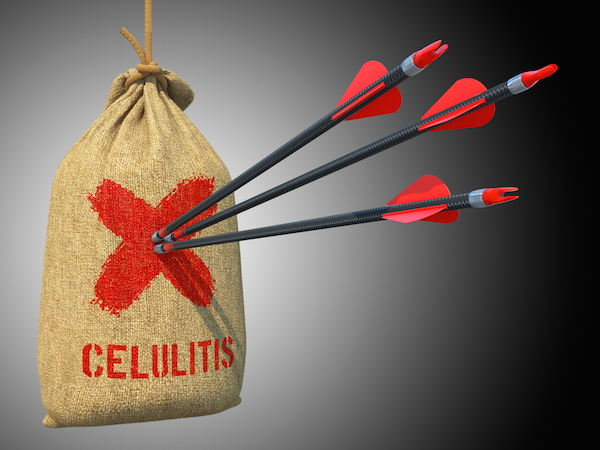 Tratamiento para la Celulitis